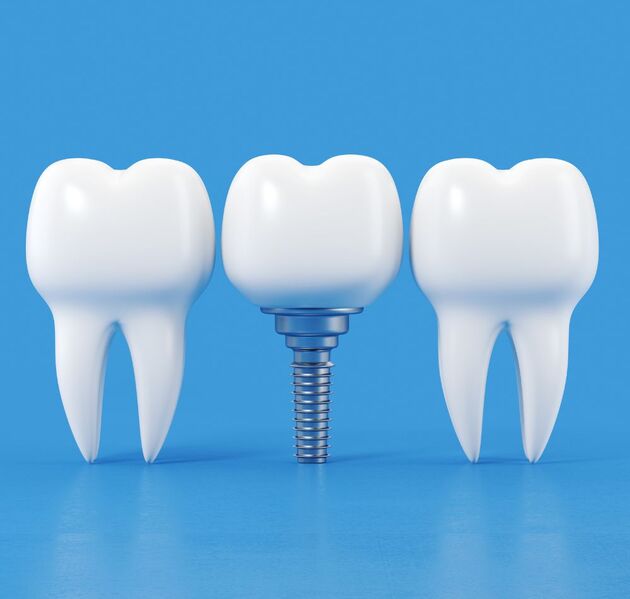 The Most Common Questions About Dental Implants