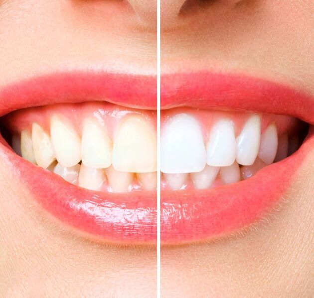 What is Tooth Bleaching? 2024 | WorldClinics.Net