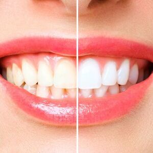 What is Tooth Bleaching?
