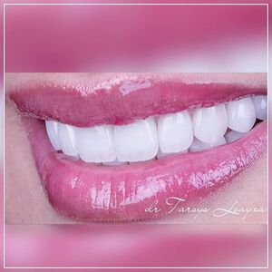 Sonrisa Perfecta Dental - Tarsys Loayza Roys